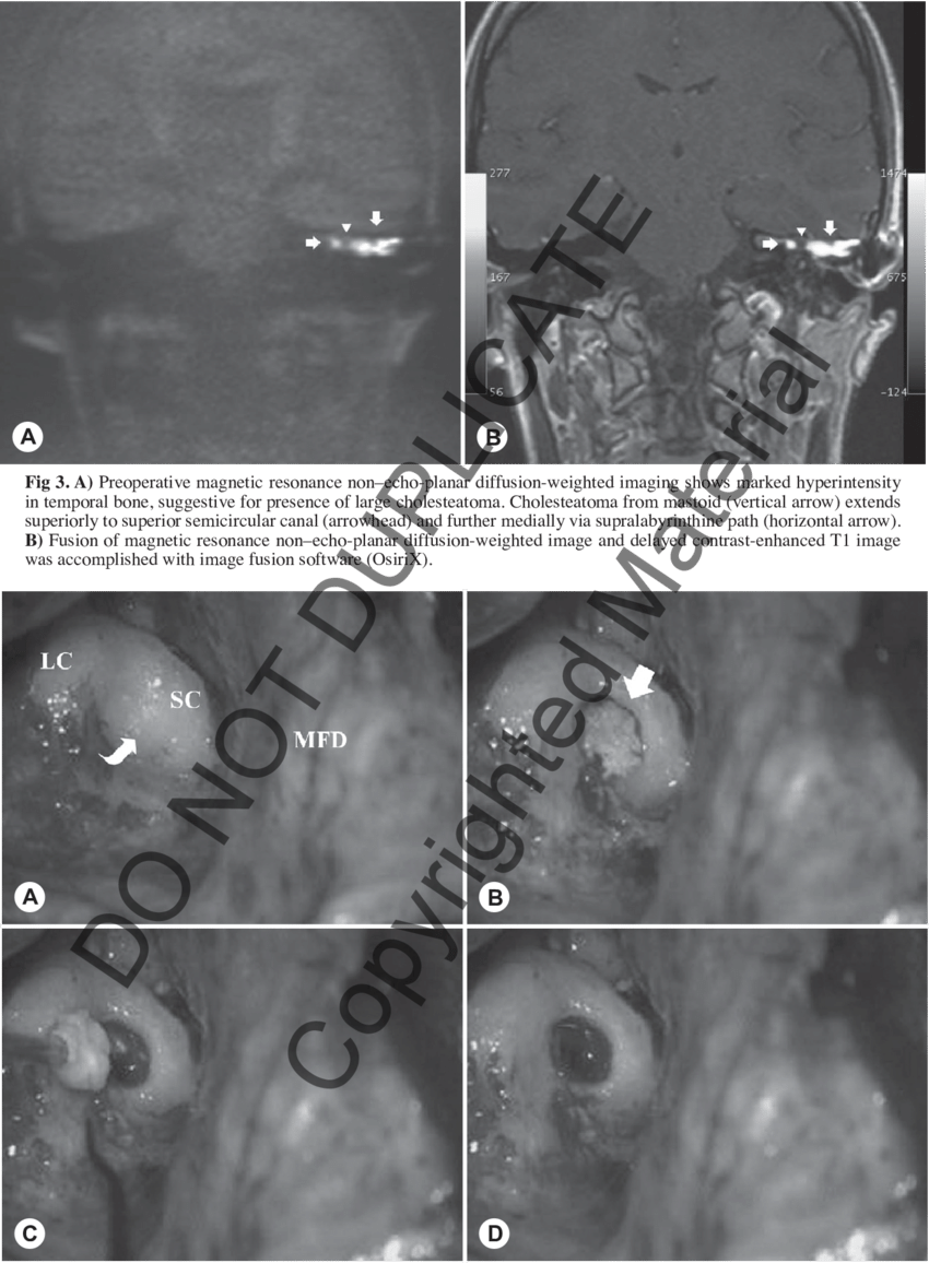 A) View Prior To Opening Subarcuate Cell Tract (arrow - Subarcuate Fossa (850x1156), Png Download