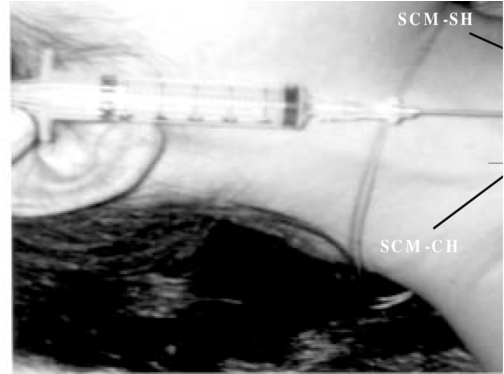 Anatomic Landmarks For The Pocket Approach And The - Monochrome (850x373), Png Download