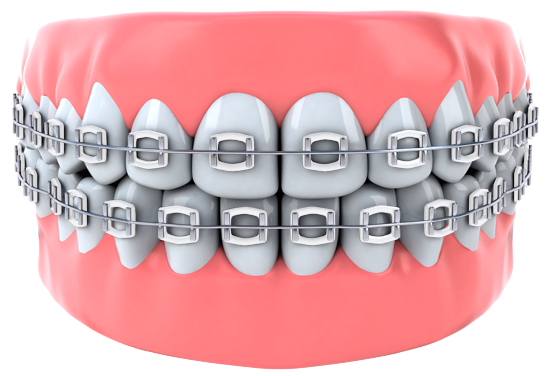 Teeth - Smoke Braces Color (550x376), Png Download