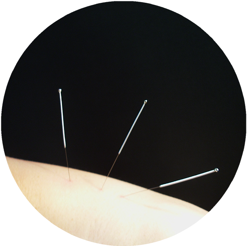 Download Acupuncture Is The Insertion Of Fine, Singleuse Needles