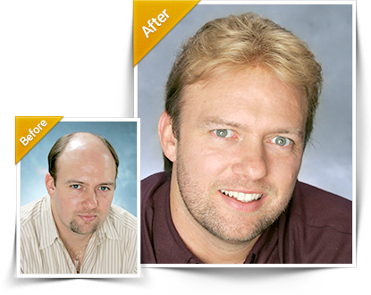 Hairpieces For Men Before And After (415x330), Png Download