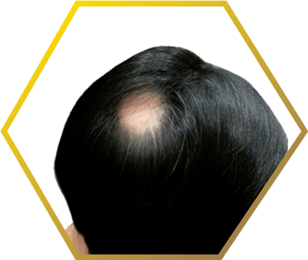Jonsson Protein Male Bald Spot - Jonsson Protein (450x380), Png Download
