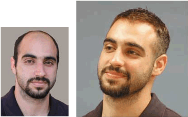 Men's Hair Replacement Systems Hair Piece Before And - Mens Hair (640x402), Png Download