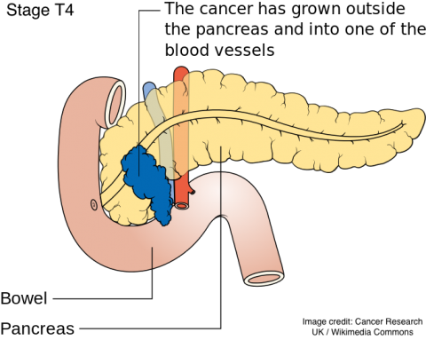 Predicting Pancreatic Cancer - Steve Jobs Murio De Cancer (480x383), Png Download