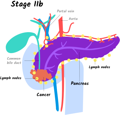 Illustration Of Stage Iib Pancreatic Cancer - Stage Iib Pancreatic Cancer (396x379), Png Download