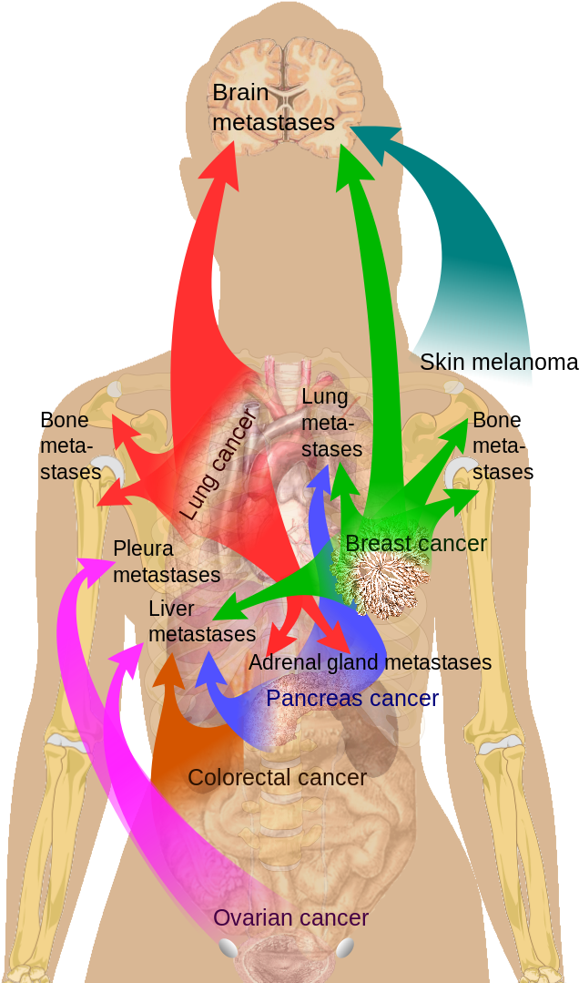 Click Here Or - Cancer Metastasis (680x1090), Png Download