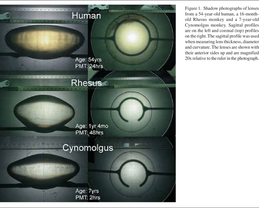 Shadow Photograph Of A 42year-old Lens Removed From - Human Lens Removed (850x683), Png Download