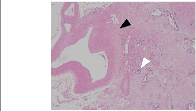 The Pathological Examination Revealed That The Tumor - Poster (850x387), Png Download