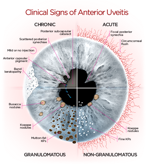 Optometry School, Anatomia Ocular, Globo Ocular, Autoimmune - Signs Of Anterior Uveitis (500x558), Png Download