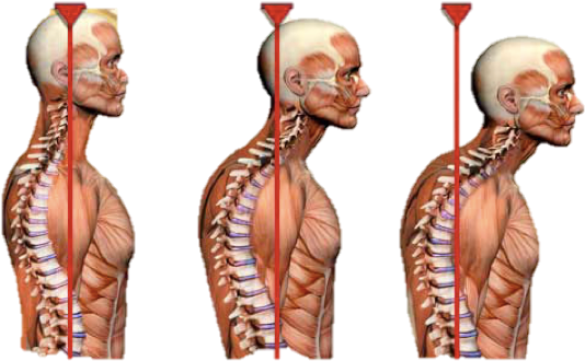 Having The Head Sitting More Forward Could Lead To - 24seven Wellness & Living Back Pain Relief Dvd (562x343), Png Download