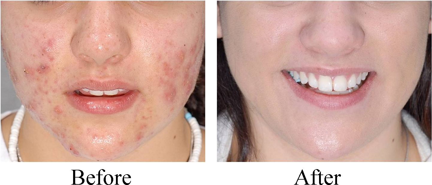 If You're Worried That Zit On Your Face Once You Wakened - Led Face Mask Before And After (1450x675), Png Download