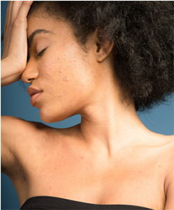 If You Suffer From Acne, You Know How Annoying It Is - Wrinkle (464x300), Png Download