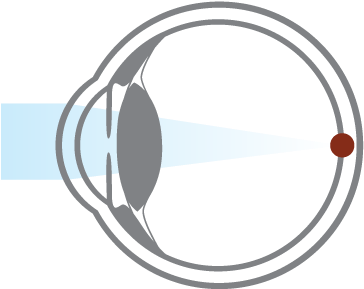 Presbyopia Is A Natural Aging Process That Usually - Circle (417x417), Png Download