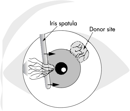 Blunt Dissection Of The Pterygium Head - Circle (505x429), Png Download