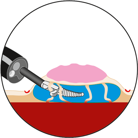 Preparation Of Submucosal Space Can Be Assisted By - Circle (531x526), Png Download