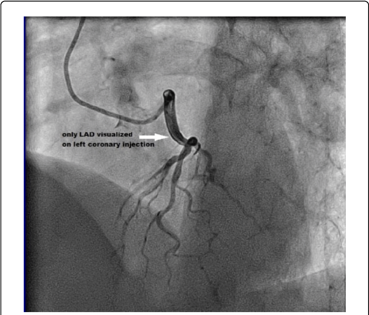 Lao Cranial View Reveals Only Lad On Left Coronary - Left Coronary Artery (770x654), Png Download