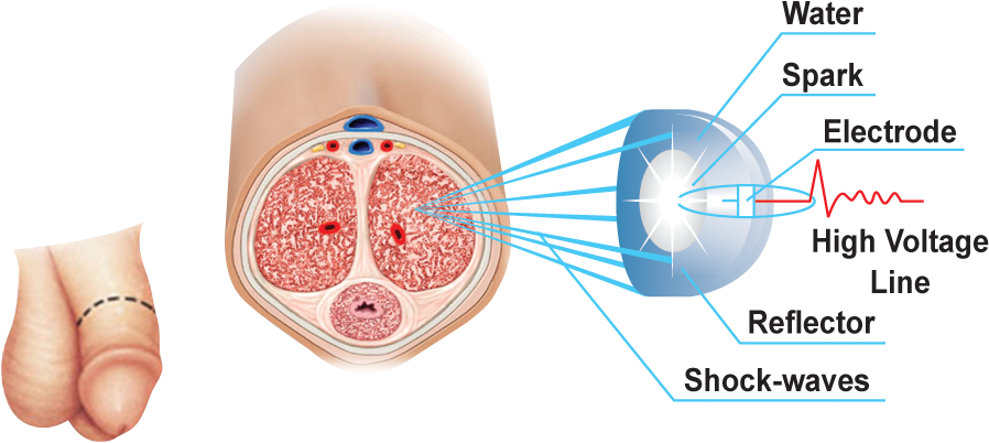 Canadian Pharmacy Survey Of The Latest Viagra Alternative - Peyroni Tedavisi (945x457), Png Download