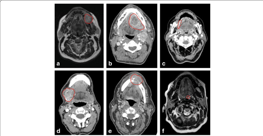 Primary Tumors Of Six Patients Encircled In Red - Neoplasm (850x439), Png Download
