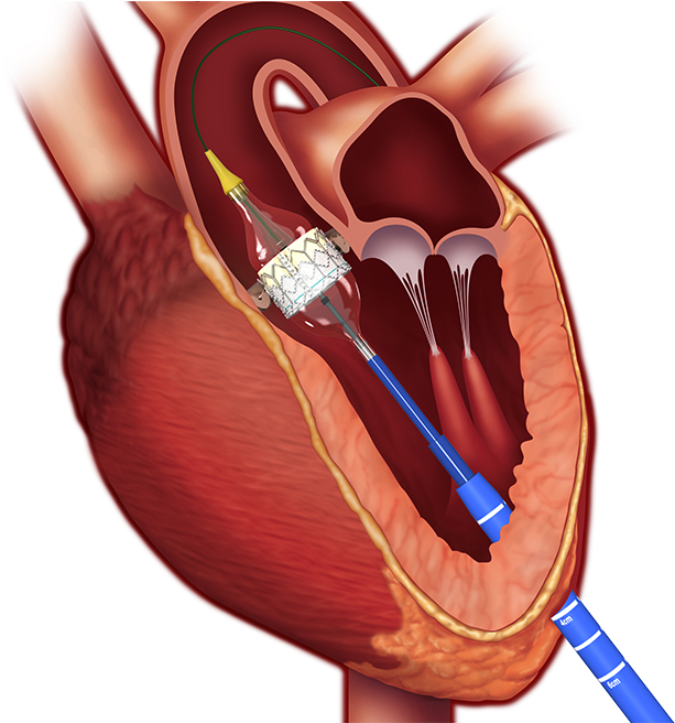 Current Team Members - Aortic Stenosis Treatment (1000x655), Png Download