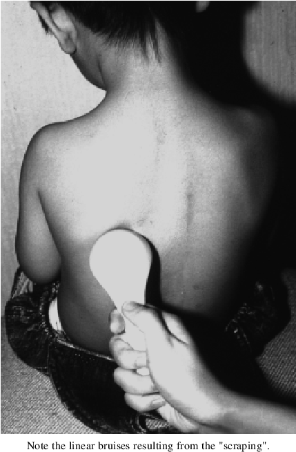 "scraping Wind" In A Child With A Porcelain Spoon - Girl (467x683), Png Download