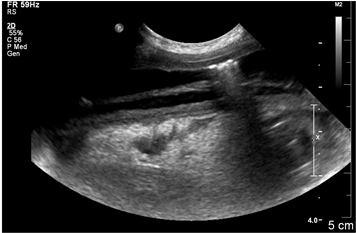 Longitudinal Image Of The Affected Small Intestine - Ultrasound (605x232), Png Download