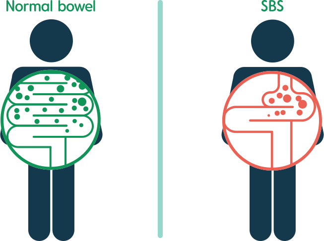 Whereas, Food And Liquid Remain In A Normal Bowel For - Short Bowel Syndrome (653x486), Png Download