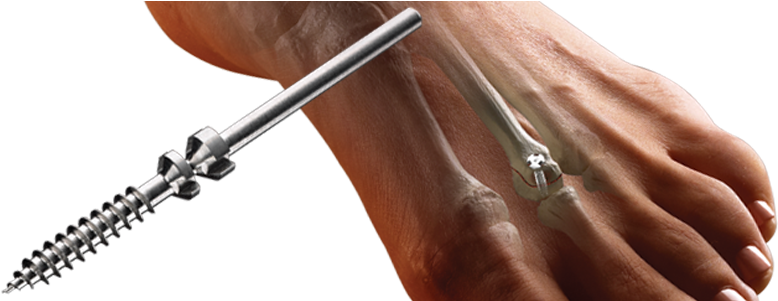 Charlotte™ Snap-off Screws - Twist Off Screw (847x300), Png Download