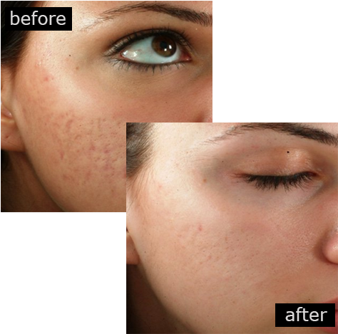 Acne Scar Removal With Outstanding Results - Philings Before And After (481x481), Png Download
