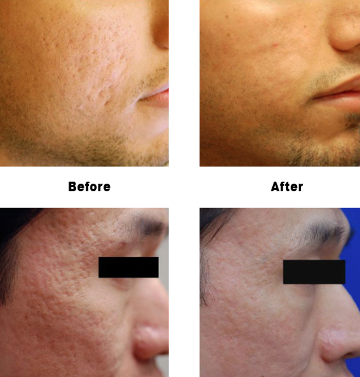 Acne Scarring Before & After Photos - Liquid Nitrogen Facial Scar (525x550), Png Download