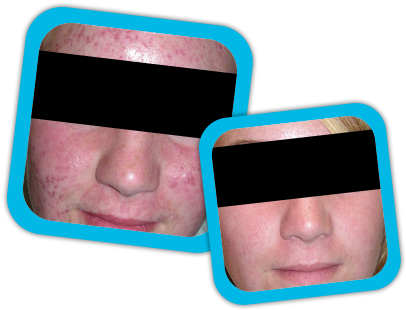 Acne Scars Result3 Acne Scars Result1 Acne Scars Result2 - Acne (415x318), Png Download