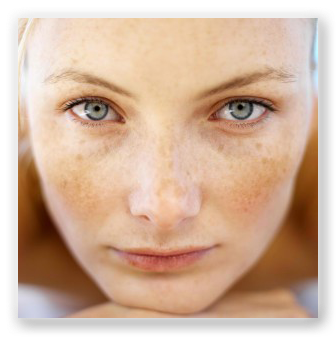 Preventing Early Acne Scars - Spots Due To Sun Exposure (350x350), Png Download