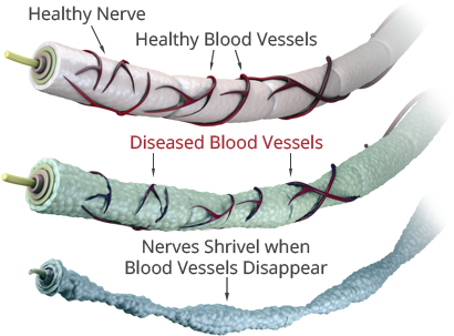 Neuropathy - Peripheral Neuropathy Nerve Damage (435x335), Png Download