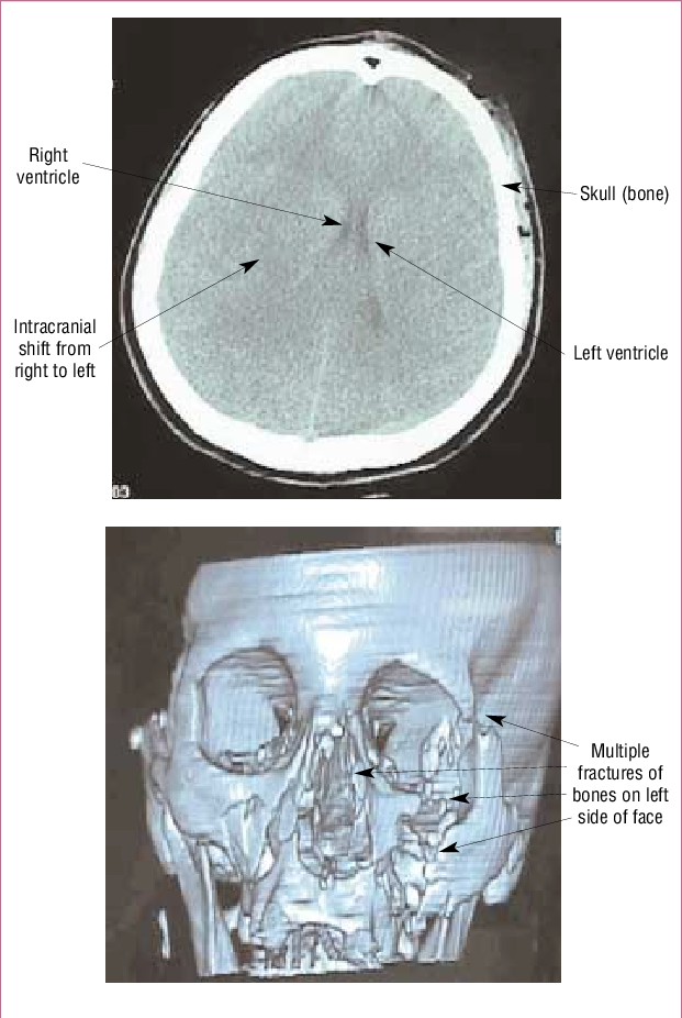 Unenhanced Ct Scans Of A - Computed Tomography (621x926), Png Download