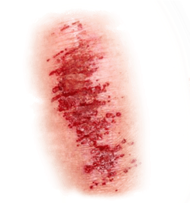 Light Wound - Wound Png (400x400), Png Download