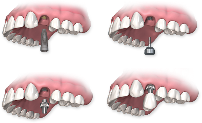 Dental Implants - Implant Healing Cap Abutment (697x435), Png Download