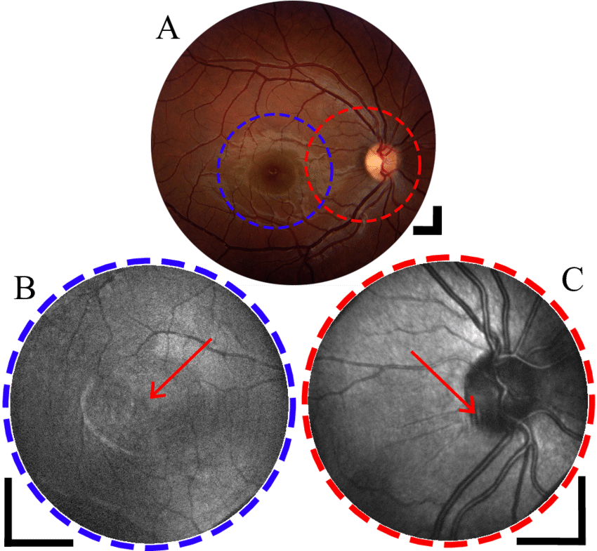 Fundus Photograph Of Subject 2 Showing The Macular - Kurbside Kitchen (850x785), Png Download