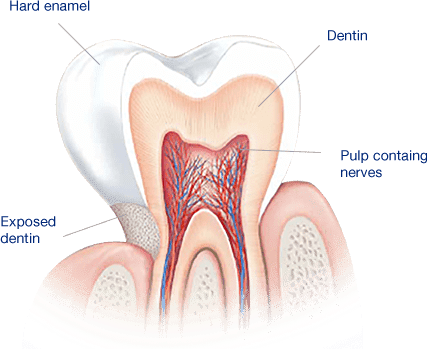What Causes Sensitive Teeth - Dentes Sensiveis (427x349), Png Download