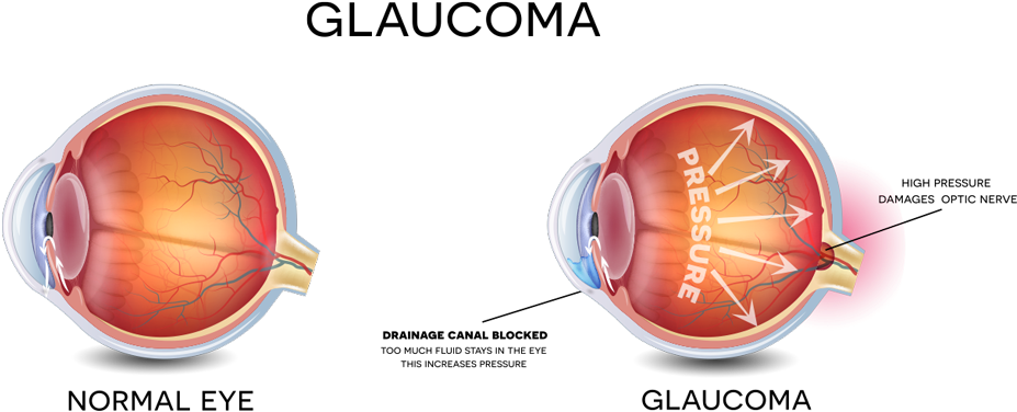 Image Result For Glaucoma - Glaucoma Eye (1000x459), Png Download