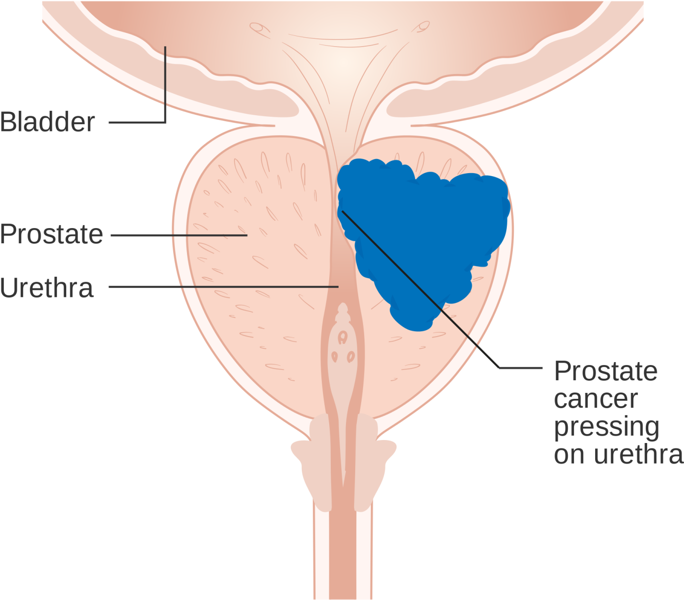 Prostate Cancer Exhibits Few Signs Or Symptoms - Prostate Cancer Androgen Receptor (1514x1368), Png Download