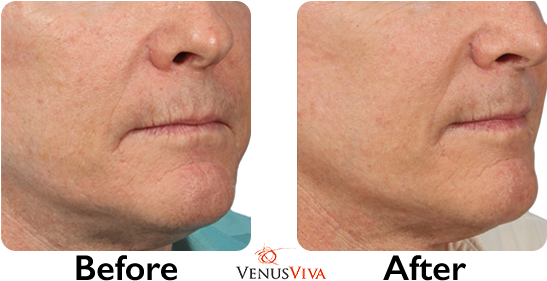 Learn More About Venus Viva™ - Venus Viva Before And After (590x310), Png Download
