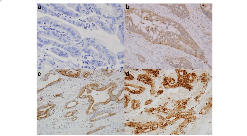 Immunostain Score Of Claudin-2 Expression In Esophageal - Esophageal Cancer (850x468), Png Download