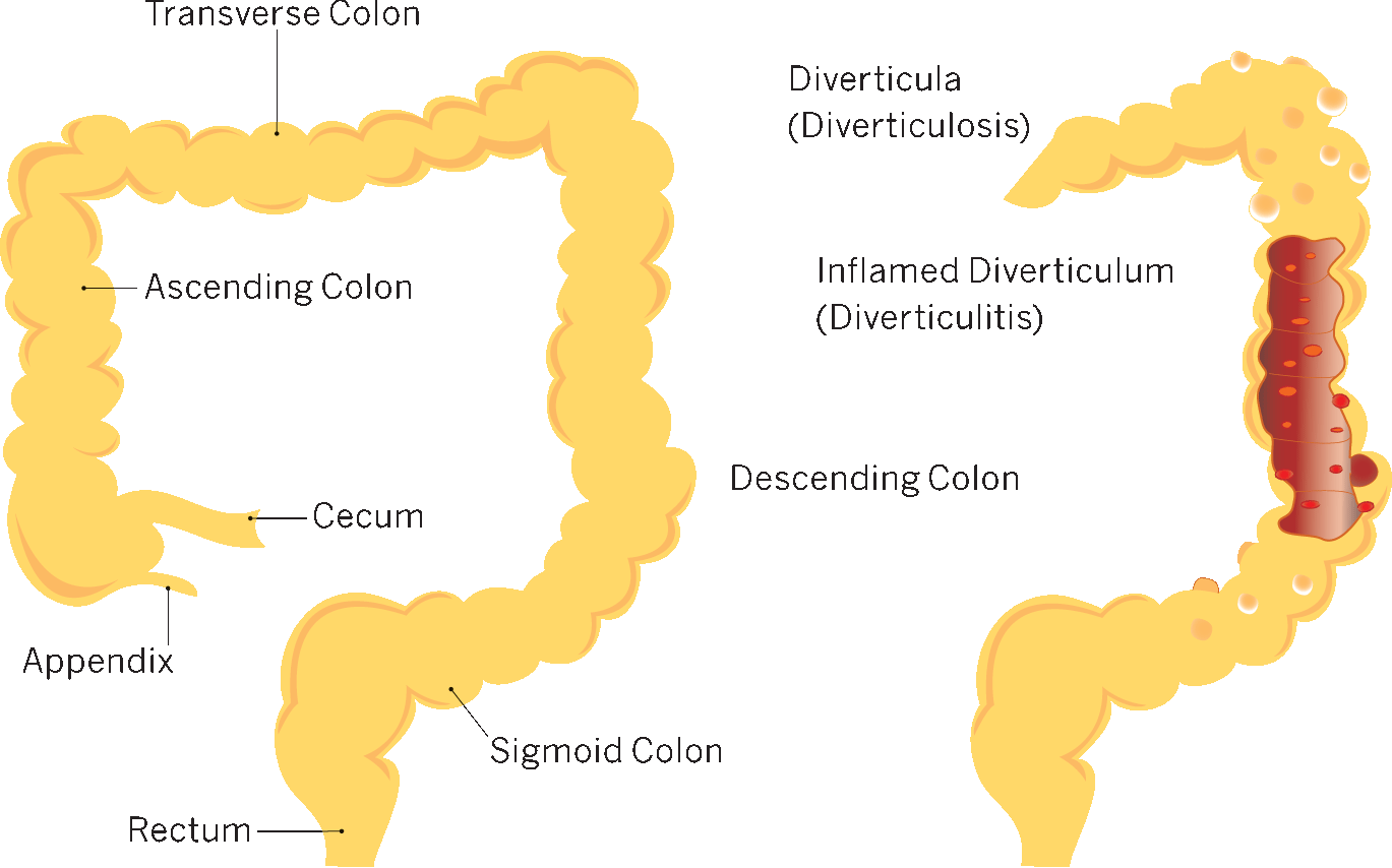 Colon-2 - Diverticulitis Transparent (1369x854), Png Download