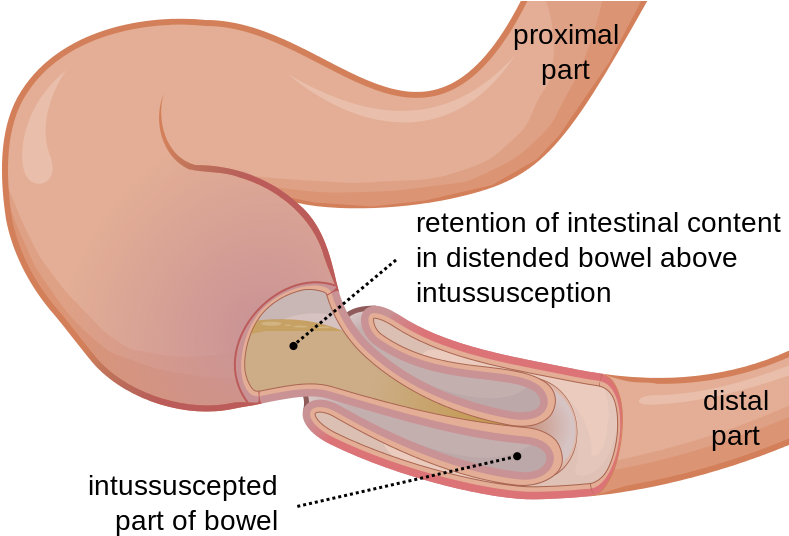 Http - Bowel Intussusception (800x550), Png Download