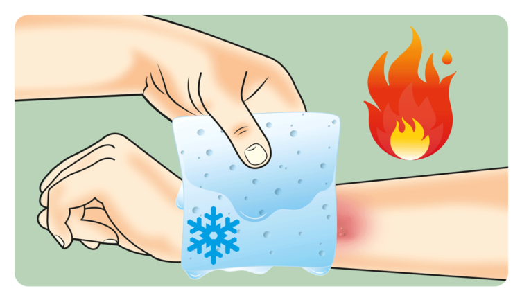 Burns The A To Z Of Rapid Treatment - Burns (768x570), Png Download
