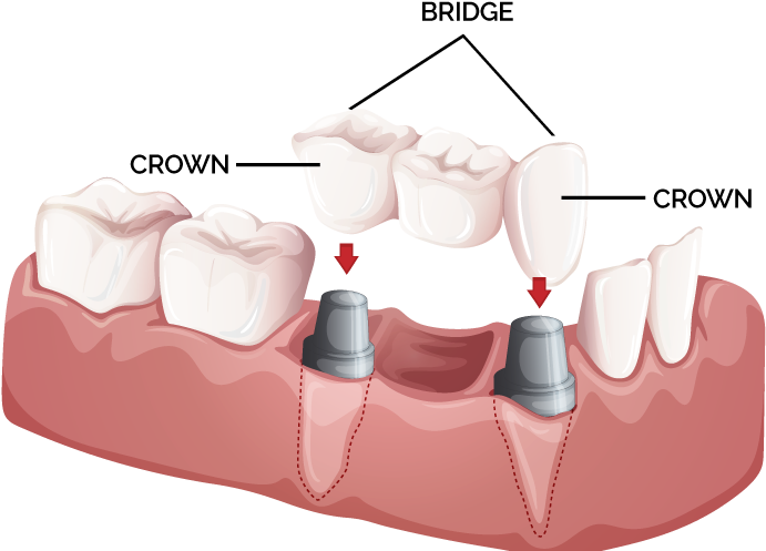 Crowns & Bridges - Dental Crowns And Bridges (727x500), Png Download