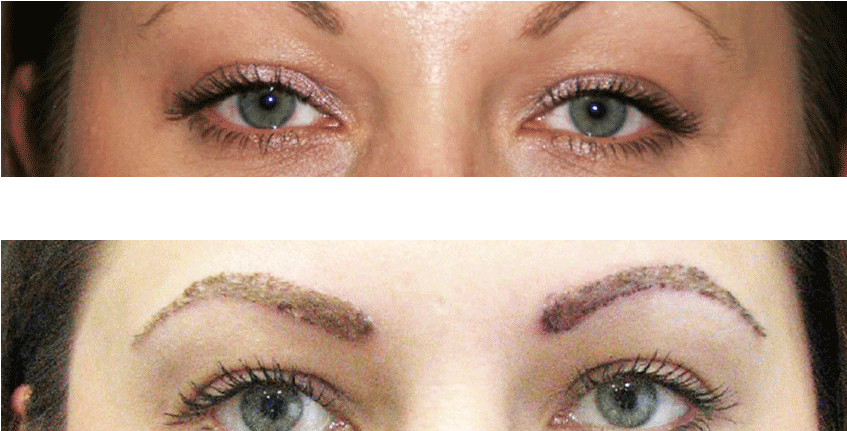 Trasplante De Cejas Antes Y Después - Eyebrow (894x430), Png Download