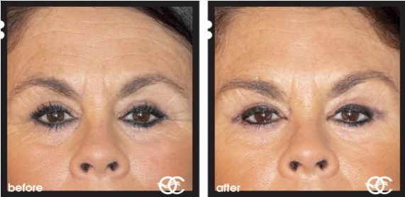 Before And After Botox - Does Botox Work (570x416), Png Download