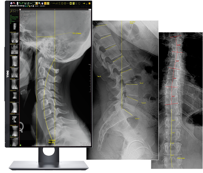 Opal-chiro Software - Digital Radiography (720x600), Png Download