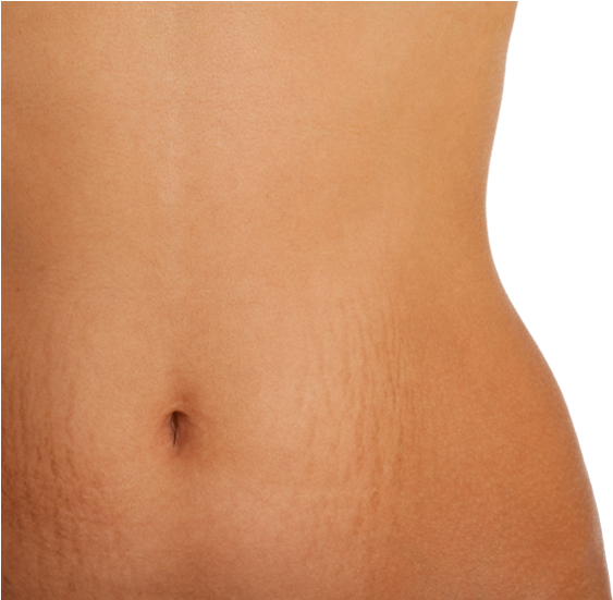 Stretch Marks Are Often The Result Of The Rapid Stretching - Mild Stomach Stretch Marks (621x550), Png Download