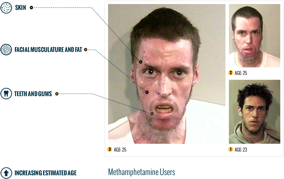 The Affects Of Meth - Meth Addict (916x678), Png Download